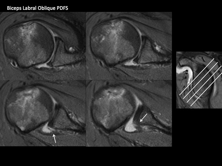 Figure 4 for case Glenoid Avulsion Glenohumeral Ligament